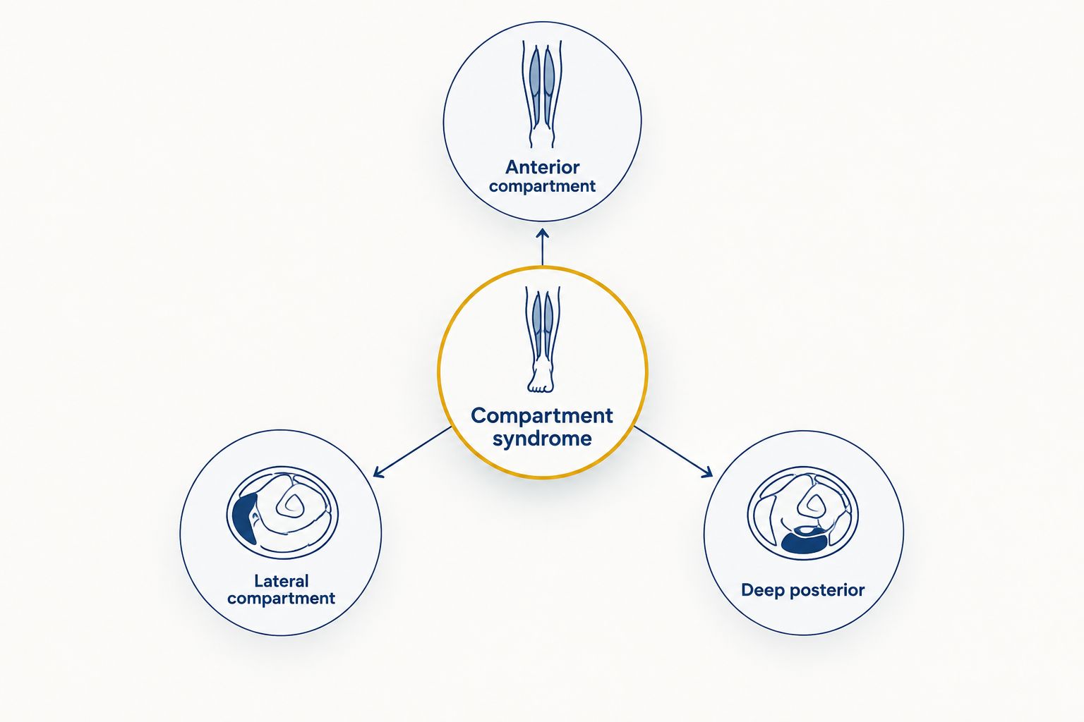 Diagram showing three lower-leg compartments linked to chronic exertional compartment syndrome