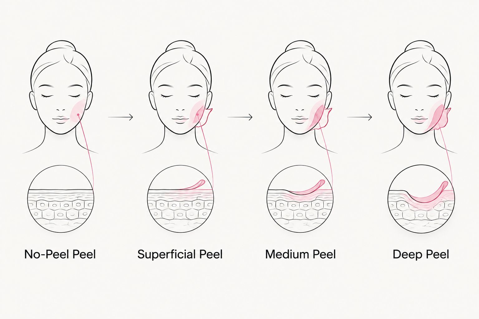 Four chemical peel depth categories shown left to right from no-peel to deep peel