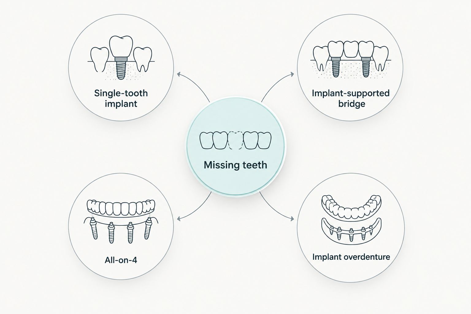 Diagram connecting missing-tooth patterns with four implant restoration options