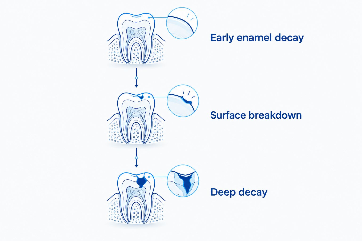 Tooth cross-sections showing early enamel decay, surface breakdown, and deep decay