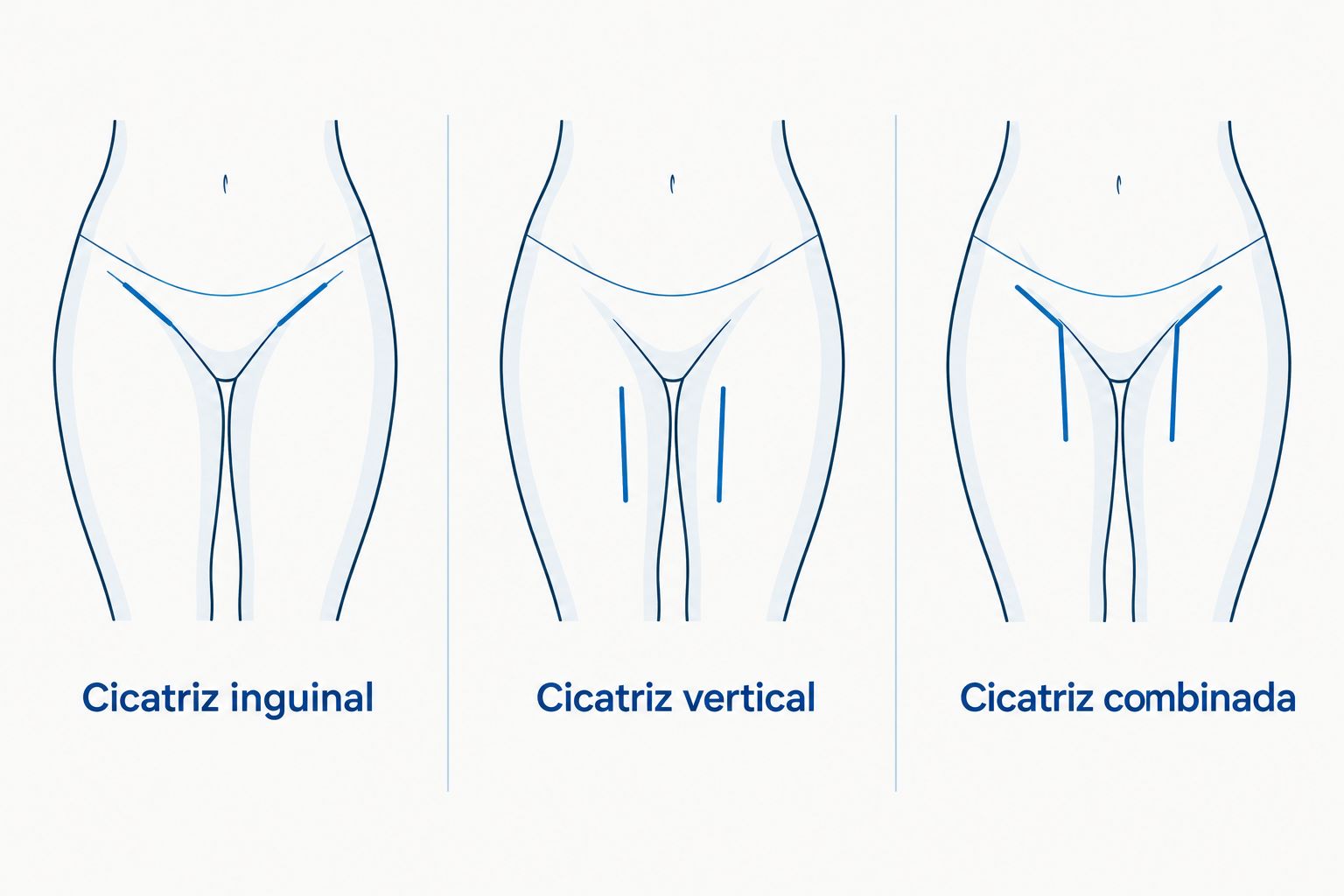 Esquema das localizações gerais das cicatrizes inguinal, vertical e combinada na cruroplastia.