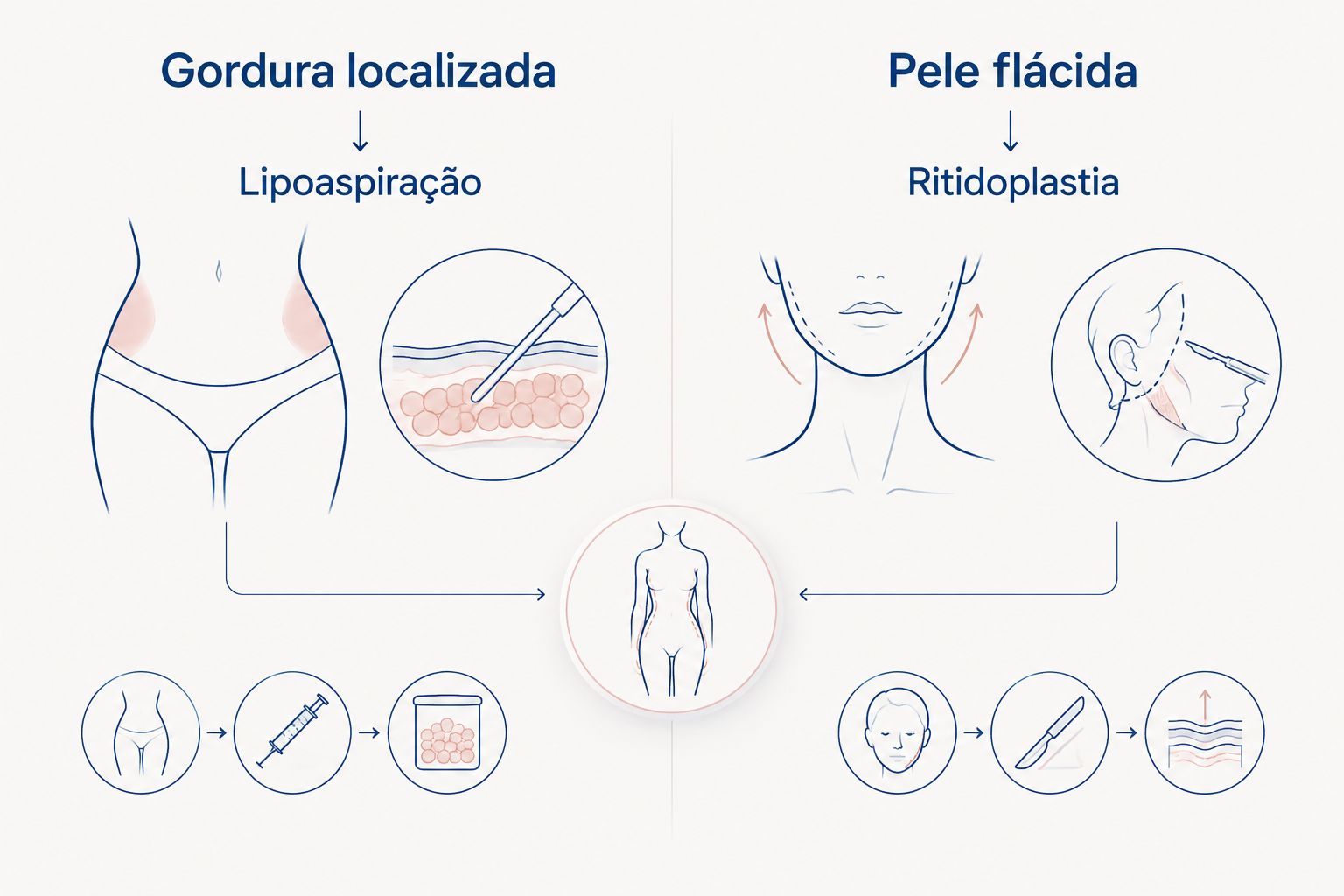 Comparação entre lipoaspiração para gordura localizada e ritidoplastia para pele flácida