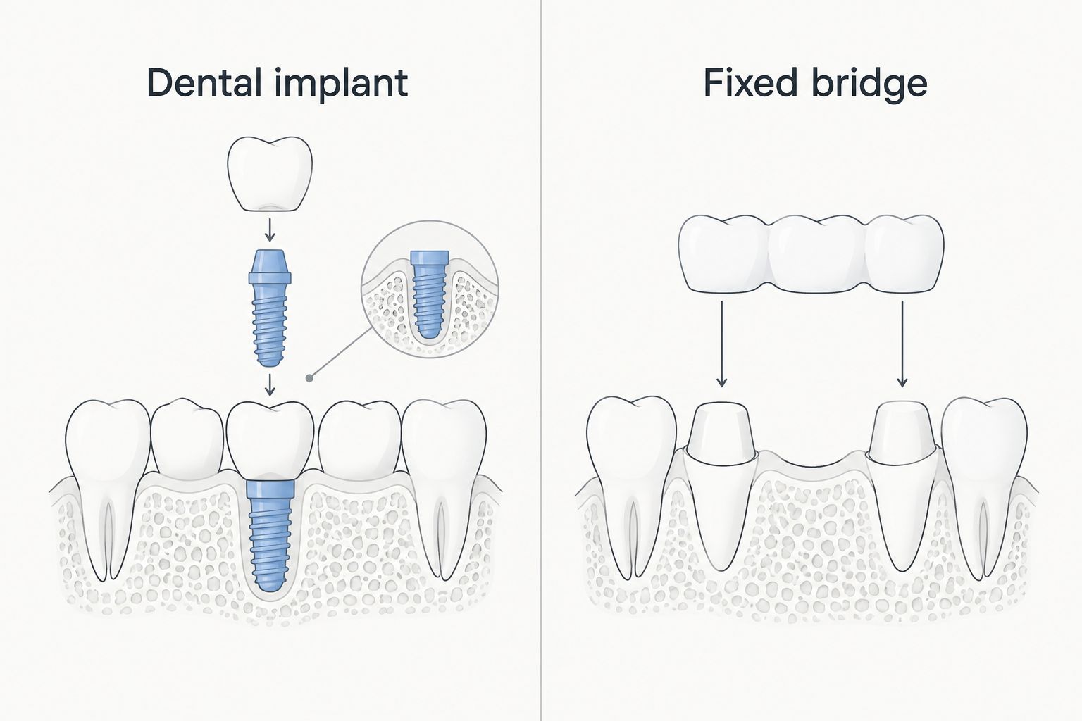 Diagram comparing jawbone support for an implant with adjacent-tooth support for a fixed bridge
