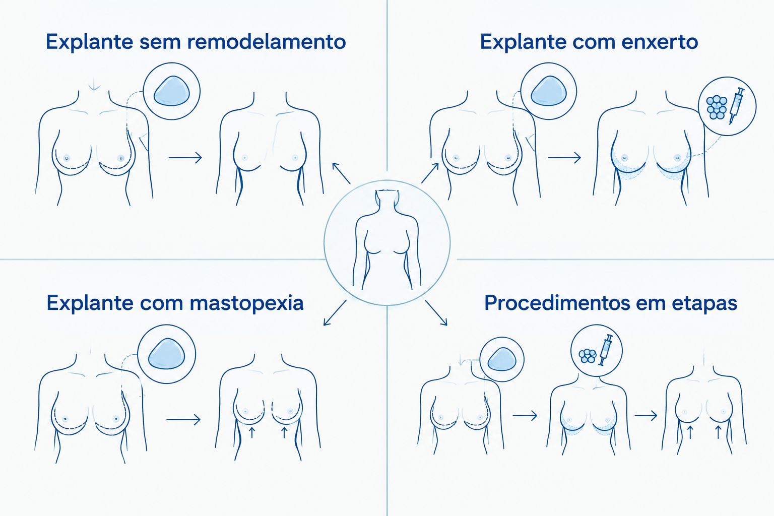 Comparação entre retirada isolada da prótese, remodelação mamária e procedimentos em etapas