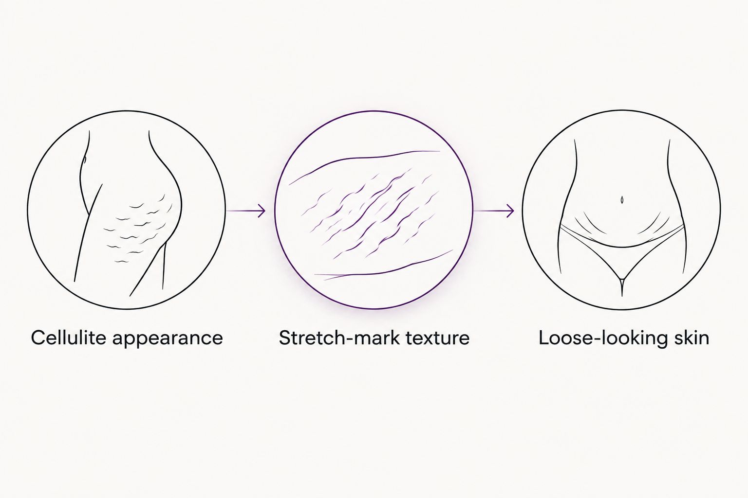 Three separate body-care goals: cellulite appearance, stretch-mark texture and loose-looking skin