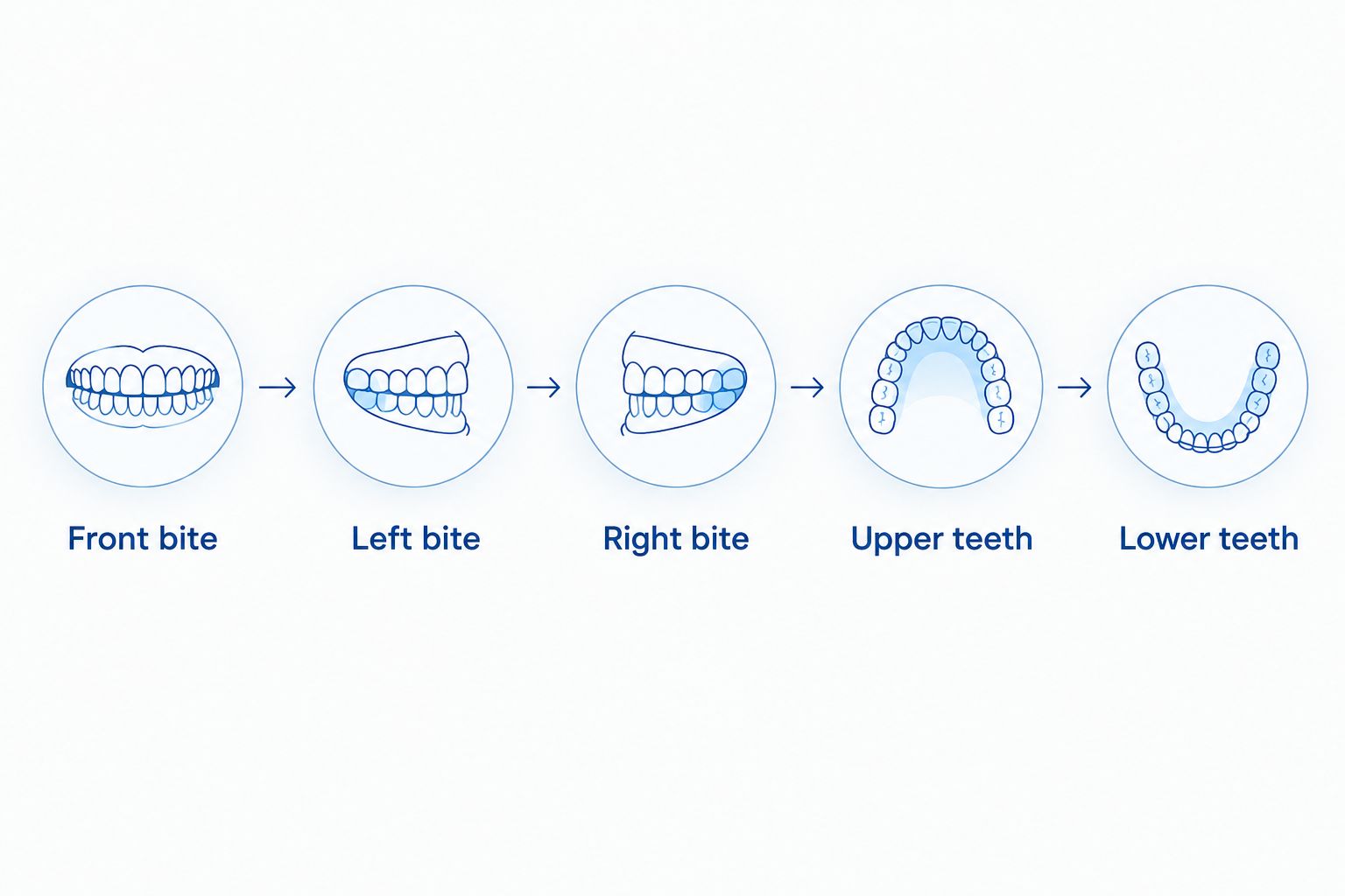 Photo sequence showing front and side bite views followed by upper and lower teeth views