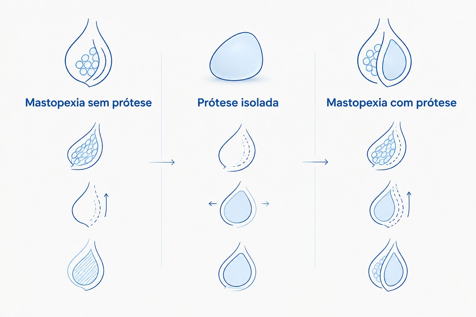 Comparação das opções de mastopexia sem prótese, prótese isolada e mastopexia com prótese.
