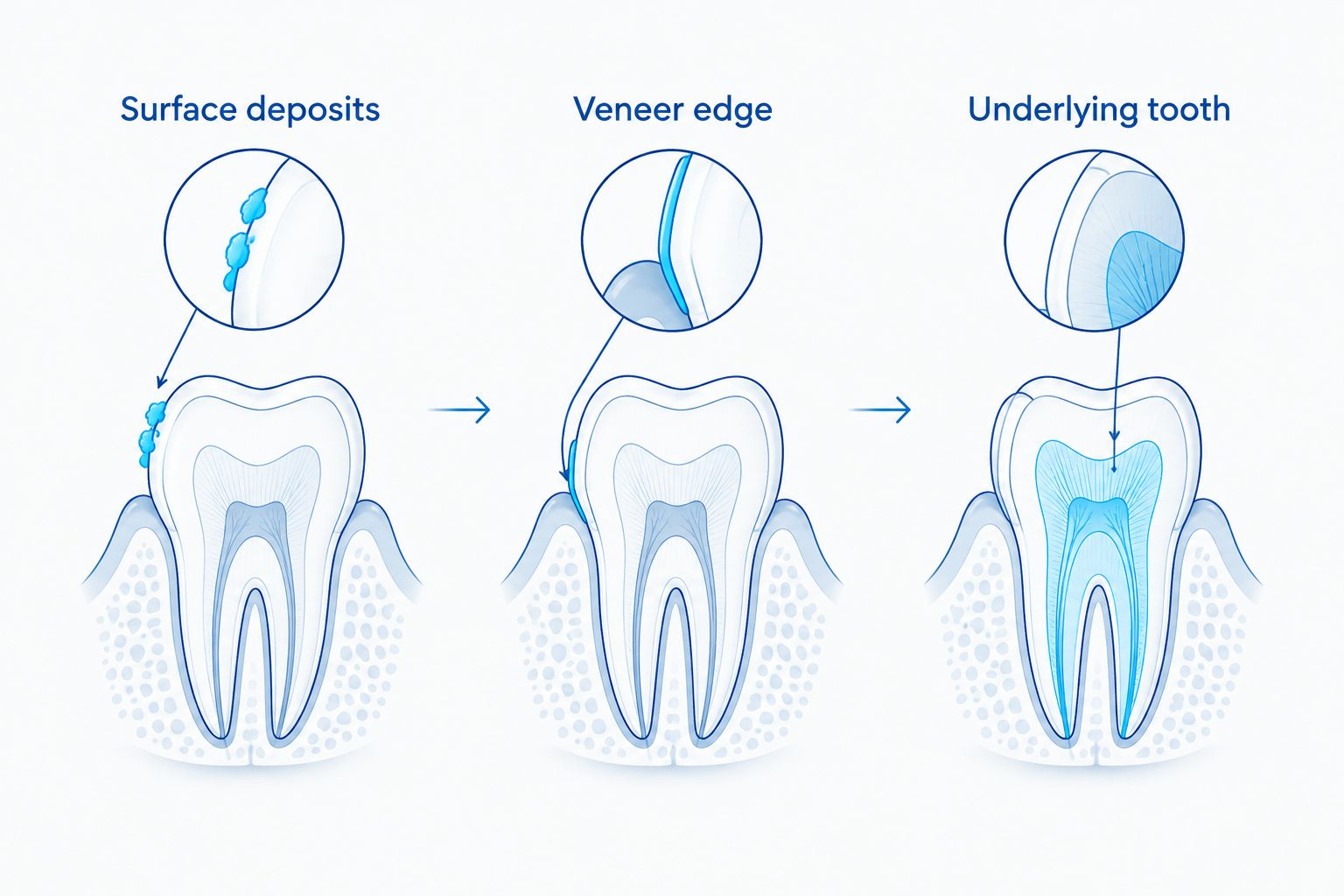 Three tooth diagrams showing discoloration on a veneer surface, at its edge, and beneath it.
