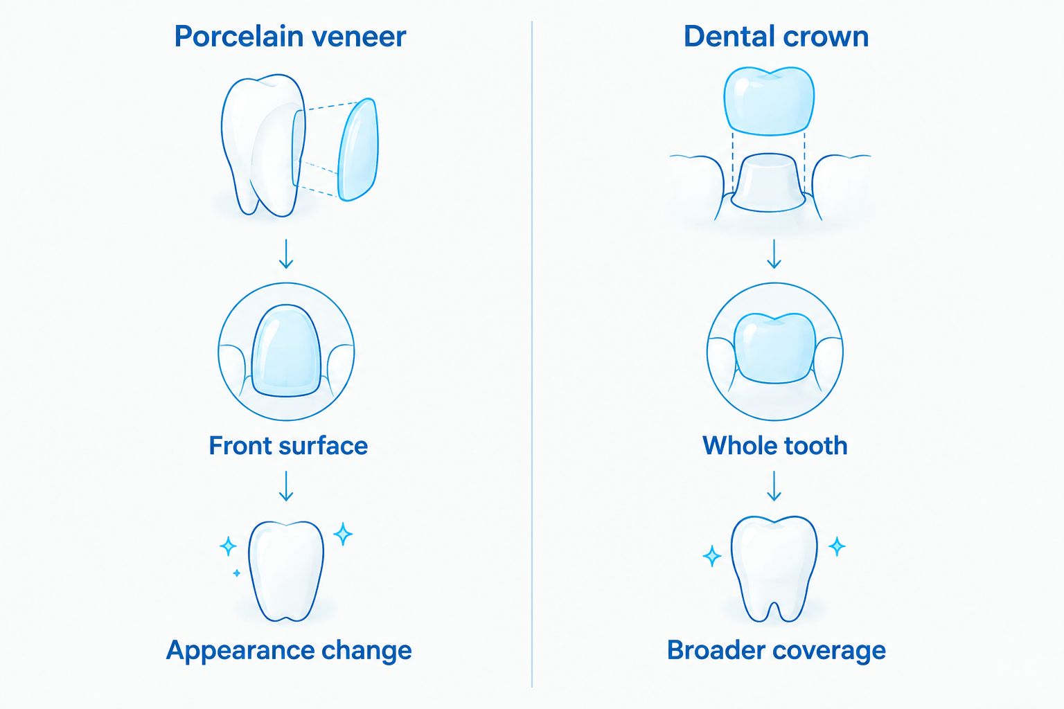 Comparison of a porcelain veneer covering the front surface and a dental crown covering the whole tooth
