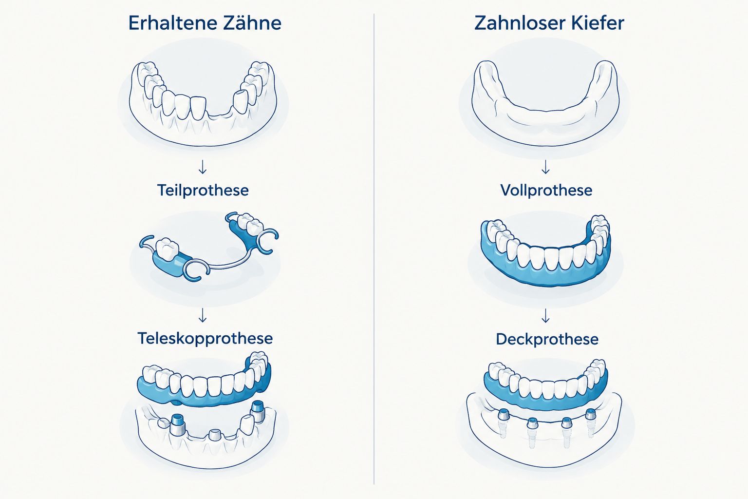 Gegenüberstellung von Prothesen bei erhaltenen Zähnen und bei zahnlosem Kiefer