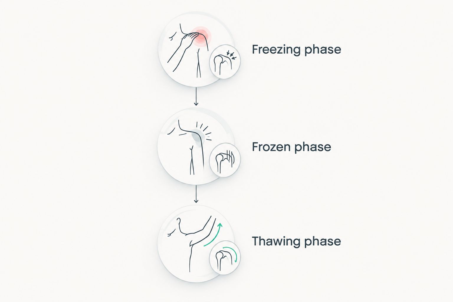 Three frozen shoulder phases showing pain, stiffness, and gradual return of movement