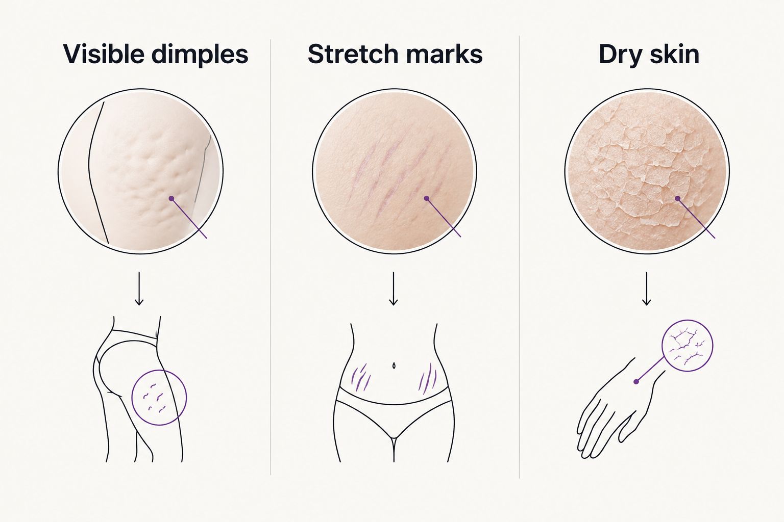 Three columns distinguish visible dimples, stretch marks, and dry skin