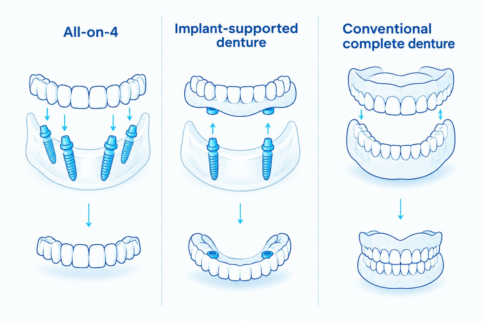 Comparison of a fixed All-on-4 bridge, a removable implant-supported denture, and a conventional denture