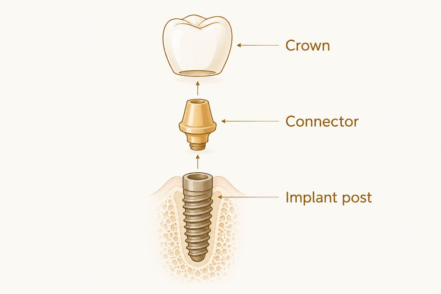 The crown, connector, and implant post shown as separate parts of a dental implant restoration.
