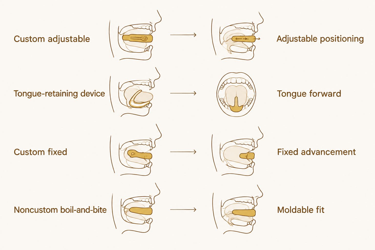 Comparison of adjustable, tongue-retaining, fixed, and boil-and-bite sleep apnea appliances