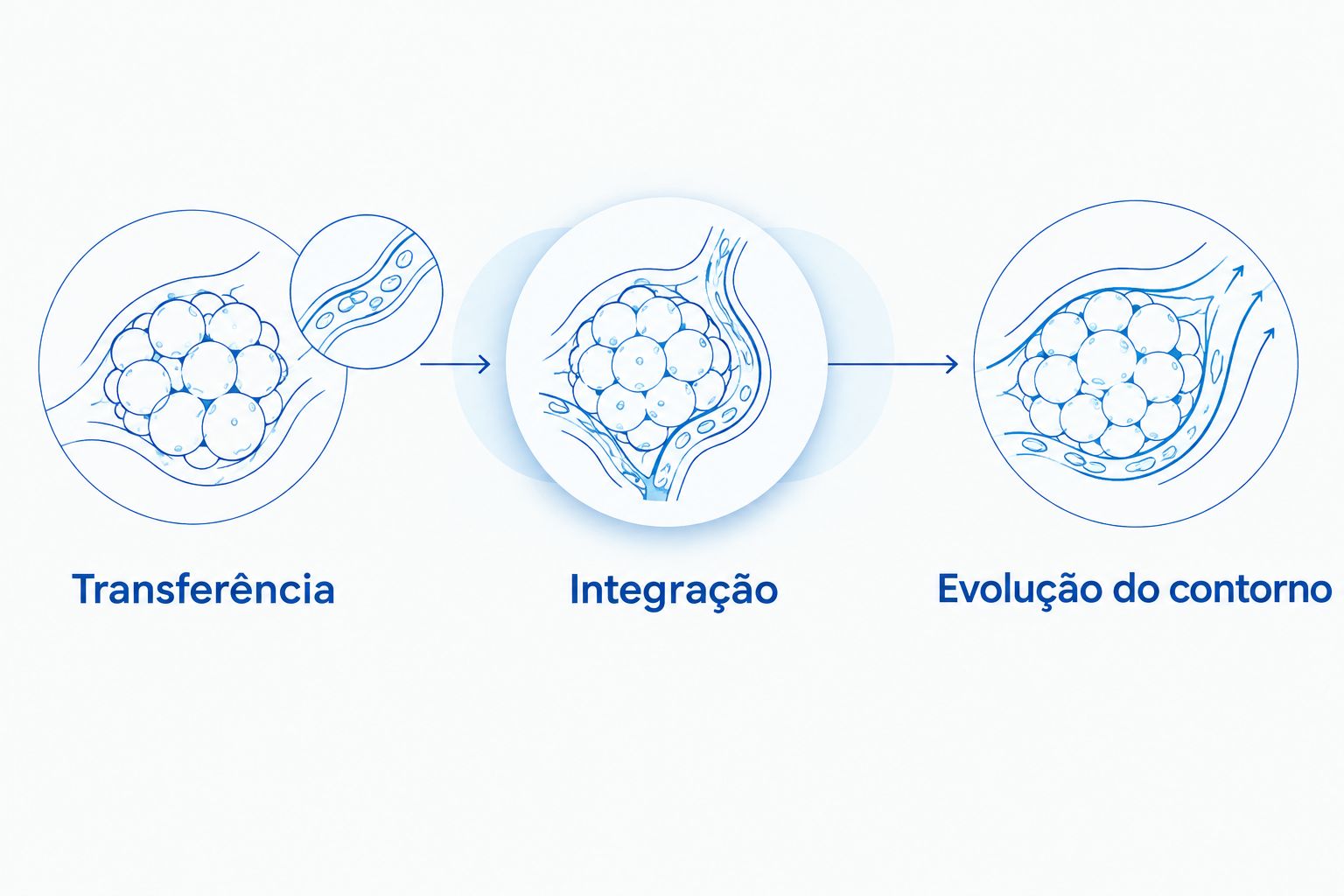 Etapas de transferência, integração da gordura e evolução do contorno após a lipoenxertia.